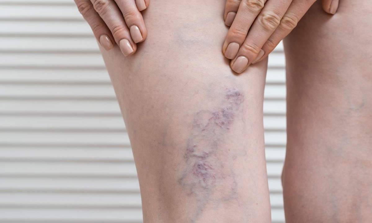 Medicamento para las varices: el tratamiento más recomendado